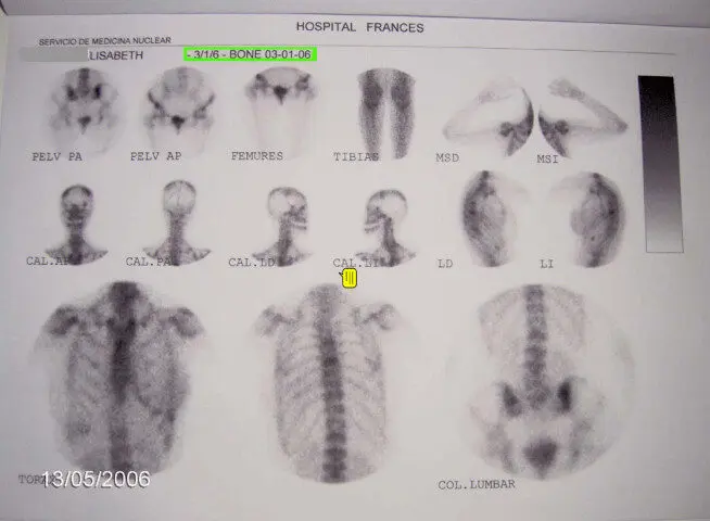 Grafologi dan Kanker